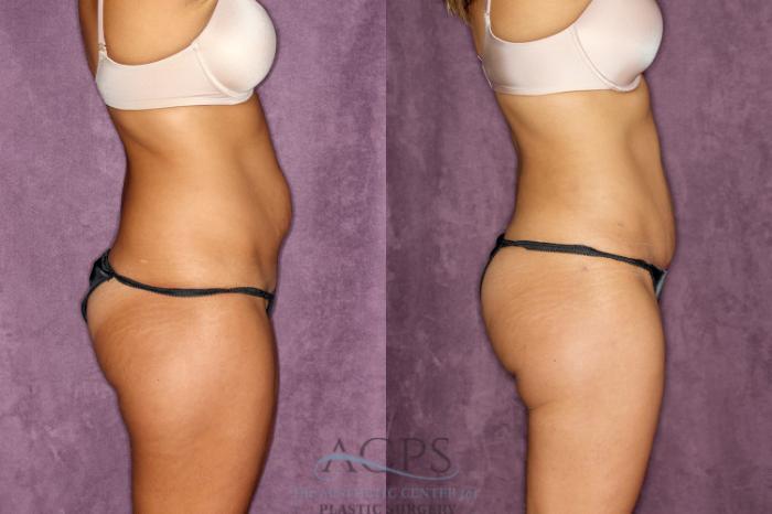 Before & After Tummy Tuck Case 77 Side Right View: View in Houston, TX