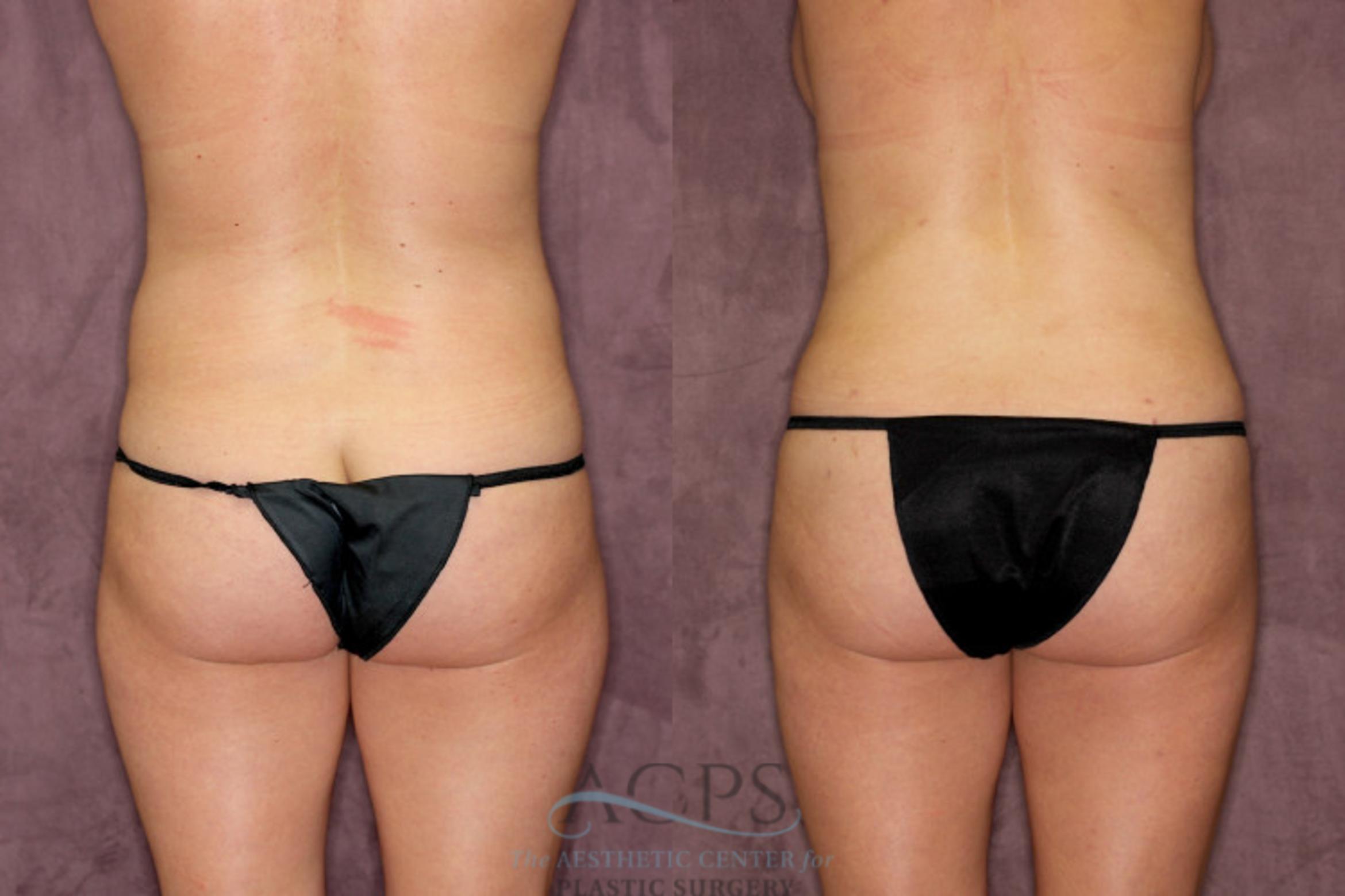 Before & After Tummy Tuck Case 78 Rear View: View in Houston, TX