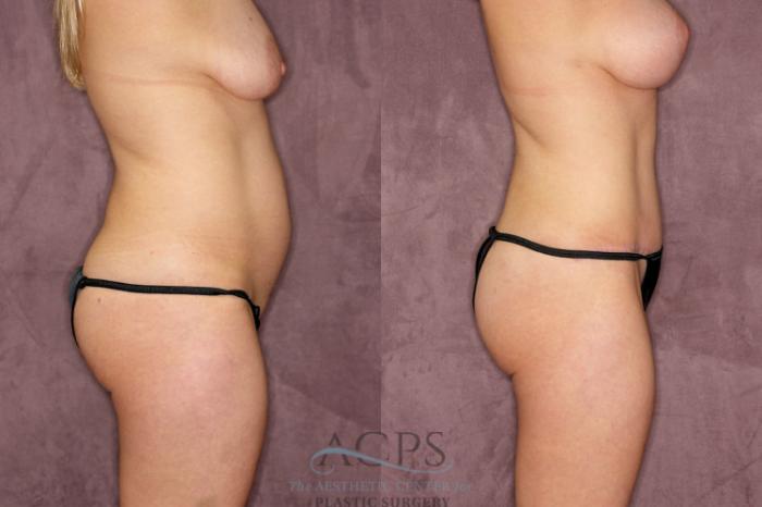 Before & After Tummy Tuck Case 78 Side Right View: View in Houston, TX