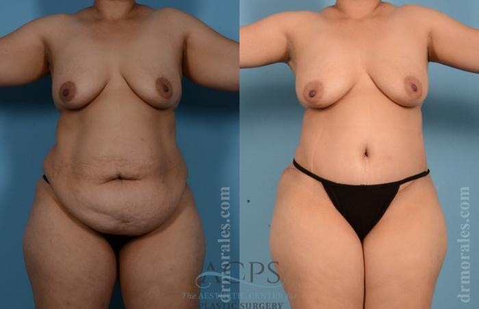 Before & After Tummy Tuck Case 8 Front View: View in Houston, TX