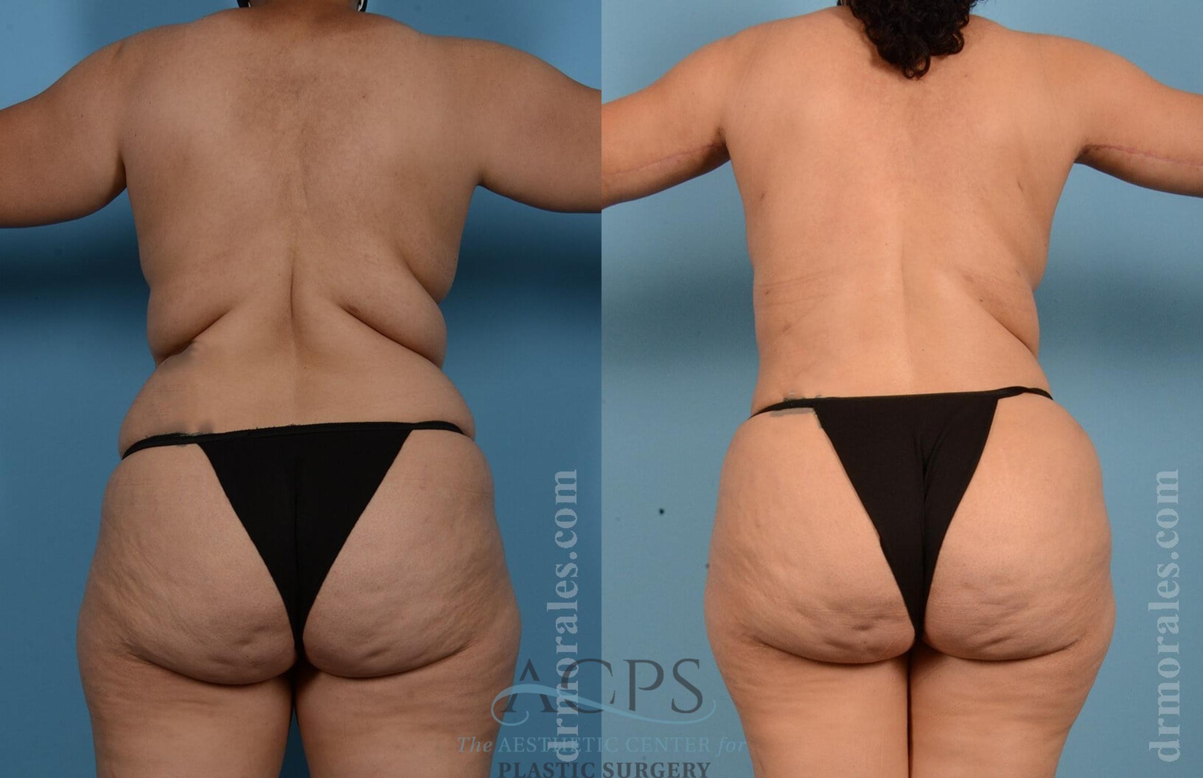 Before & After Tummy Tuck Case 8 Rear View: View in Houston, TX