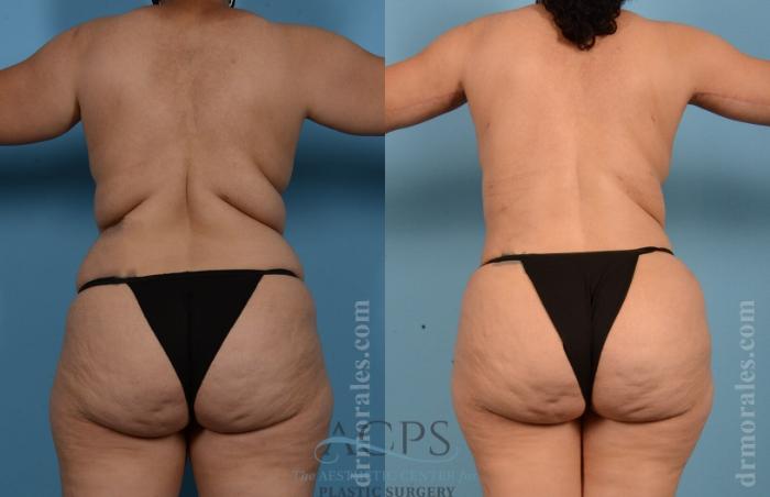 Before & After Tummy Tuck Case 8 Rear View: View in Houston, TX