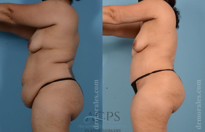 Before & After Tummy Tuck Case 8 Side View: View in Houston, TX