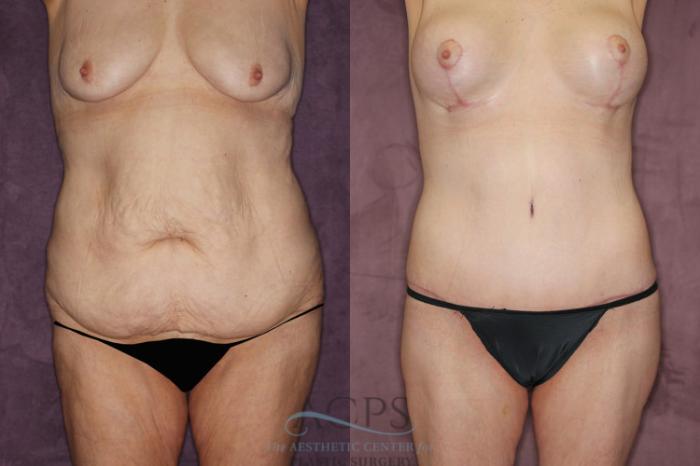 Before & After Tummy Tuck Case 80 Front View: View in Houston, TX