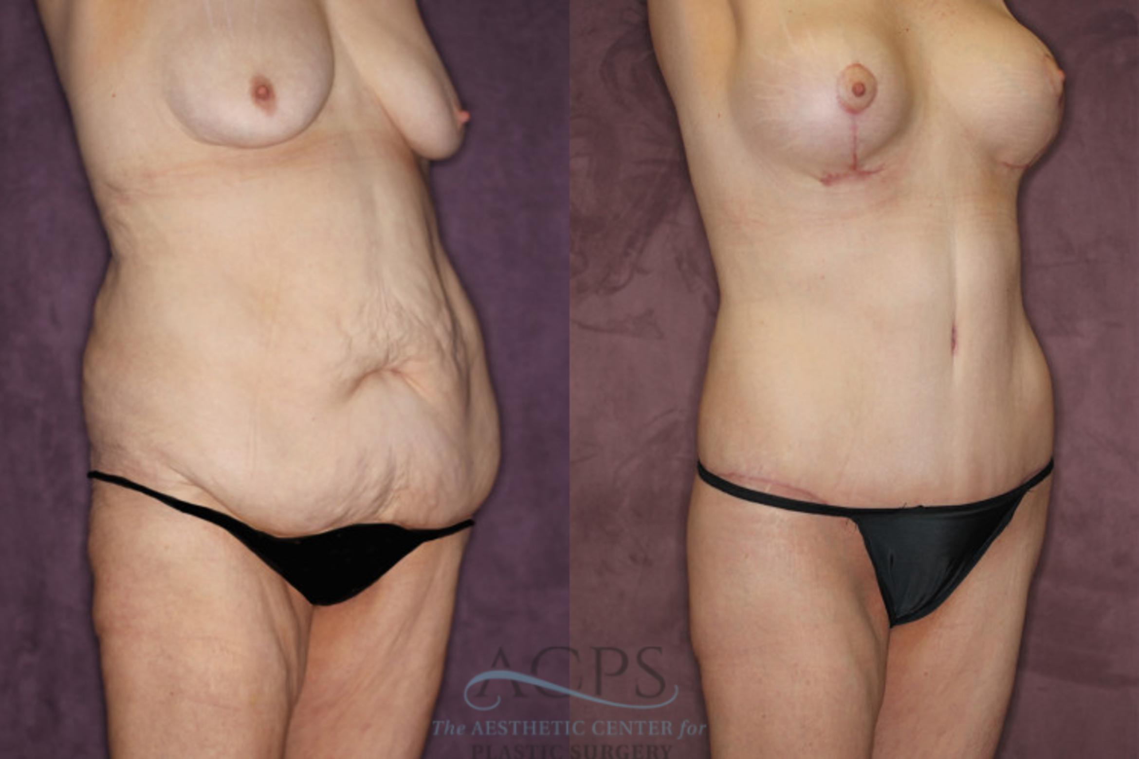 Before & After Tummy Tuck Case 80 Oblique Right View: View in Houston, TX