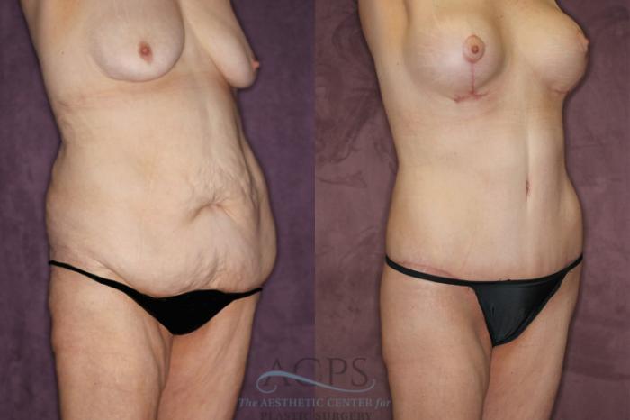 Before & After Tummy Tuck Case 80 Oblique Right View: View in Houston, TX
