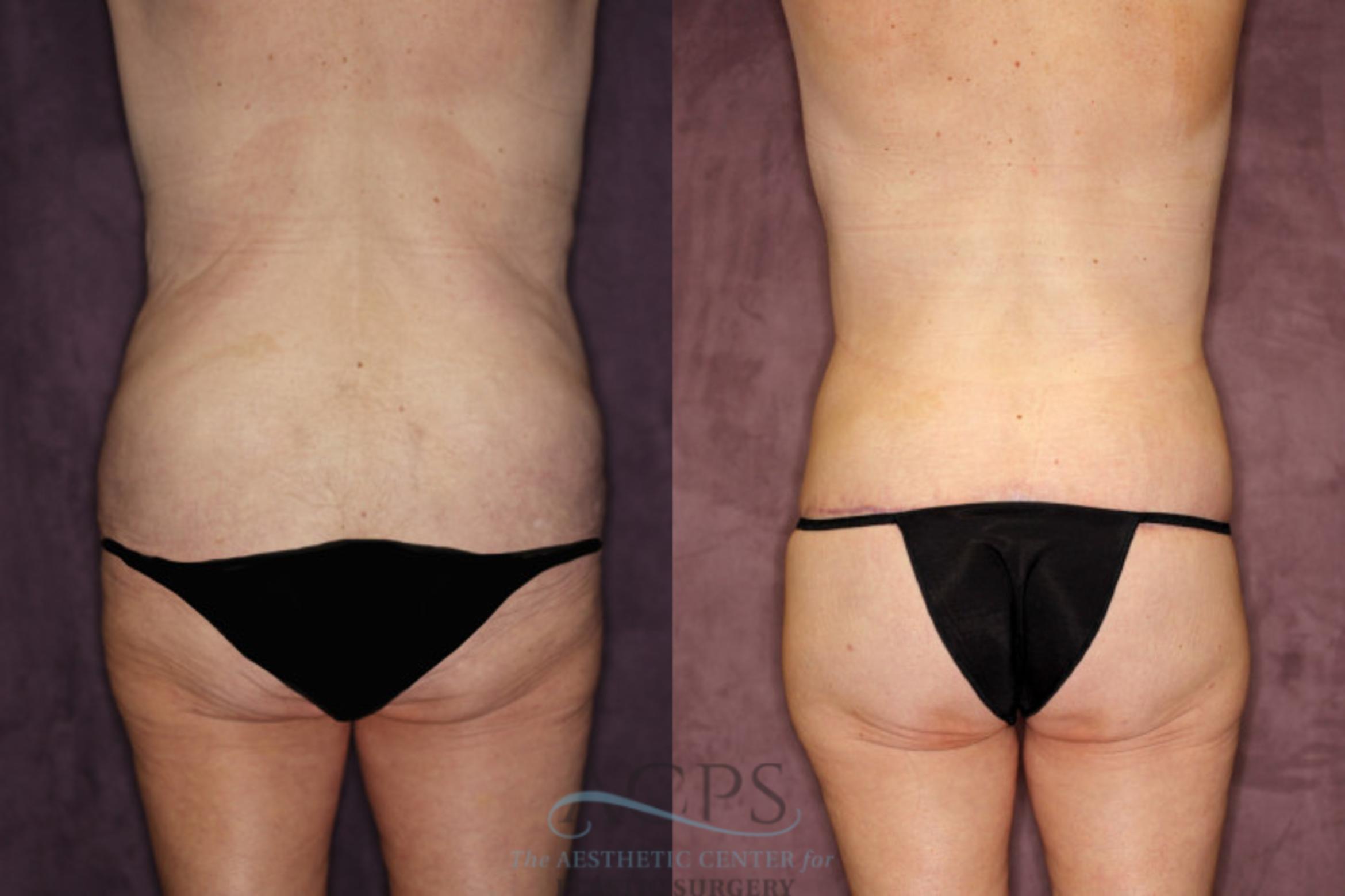 Before & After Tummy Tuck Case 80 Rear View: View in Houston, TX