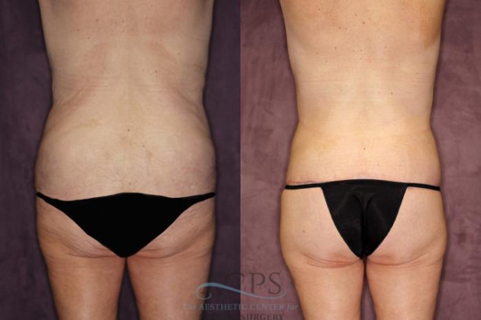 Before & After Tummy Tuck Case 80 Rear View: View in Houston, TX