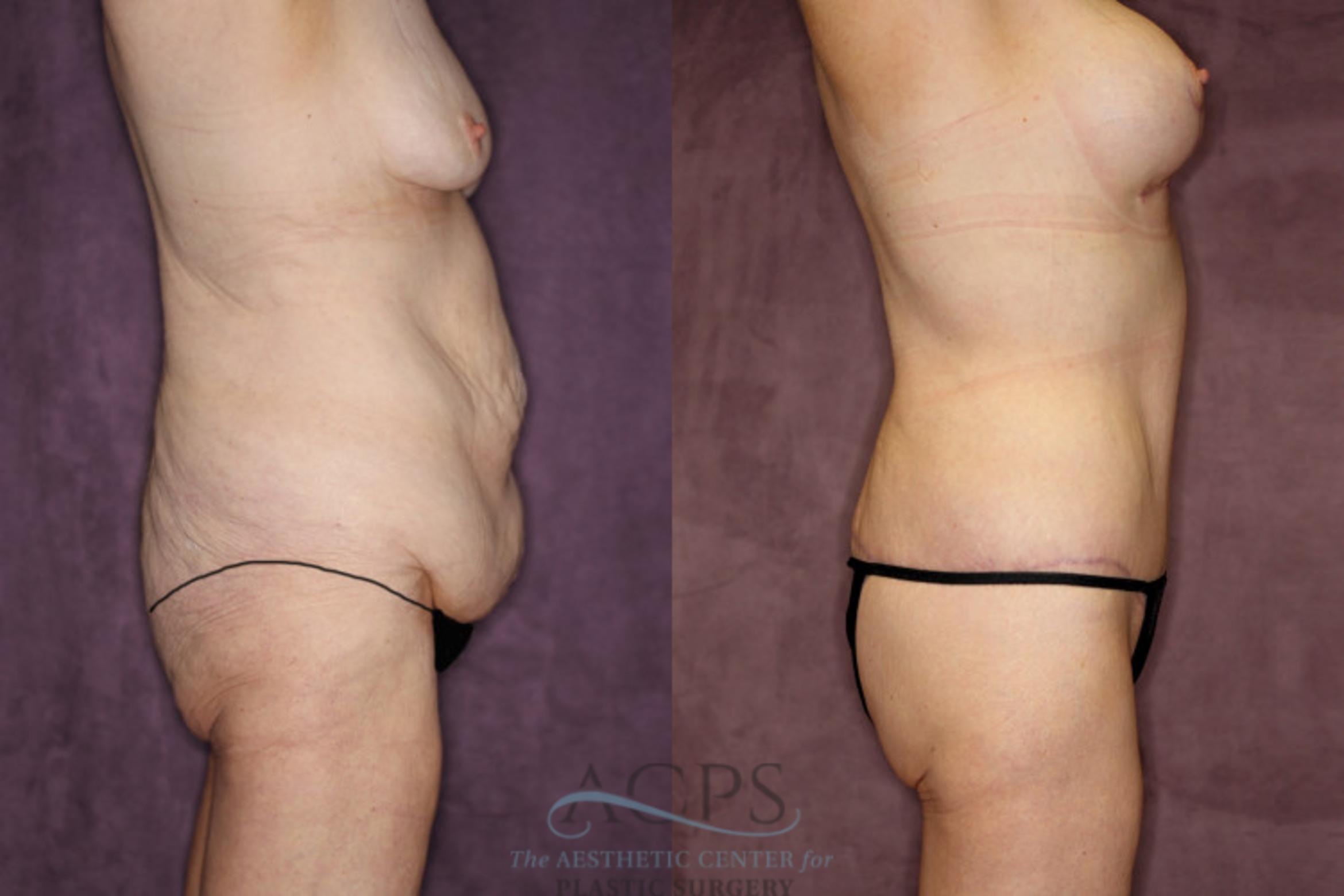 Before & After Tummy Tuck Case 80 Side Right View: View in Houston, TX
