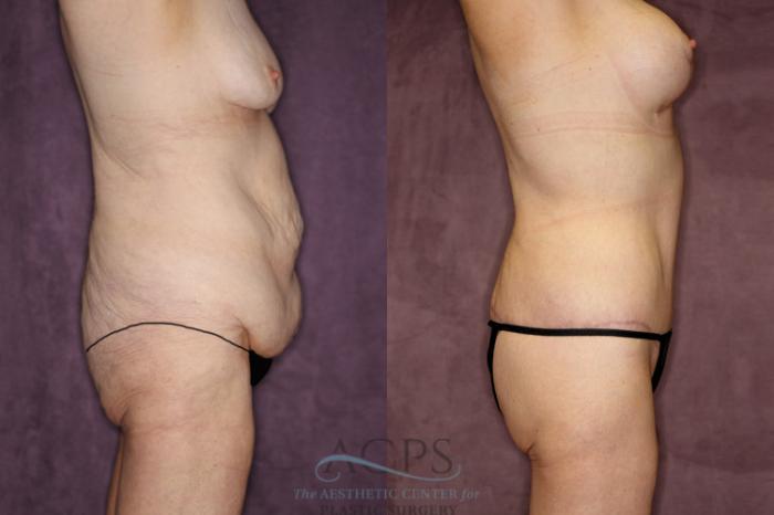 Before & After Tummy Tuck Case 80 Side Right View: View in Houston, TX