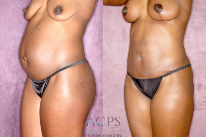 Before & After Tummy Tuck Case 81 Oblique Left View: View in Houston, TX