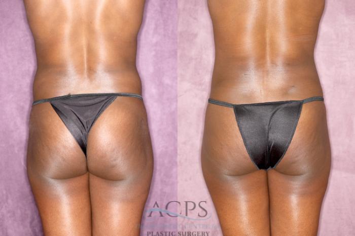 Before & After Tummy Tuck Case 81 Rear View: View in Houston, TX