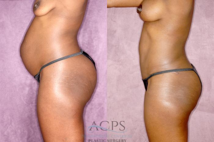 Before & After Tummy Tuck Case 81 Side Left View: View in Houston, TX