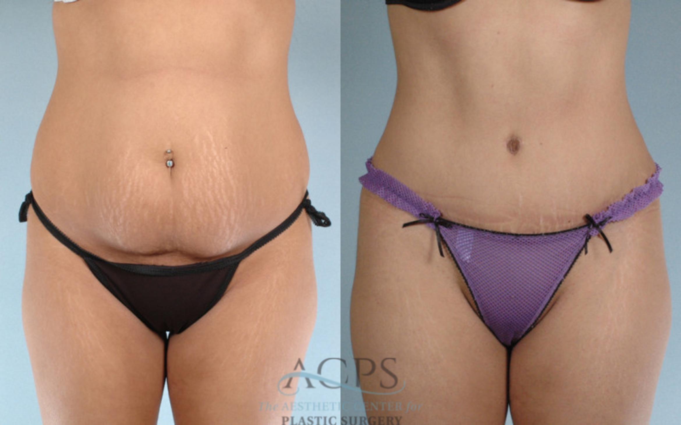 Before & After Tummy Tuck Case 82 Front View: View in Houston, TX