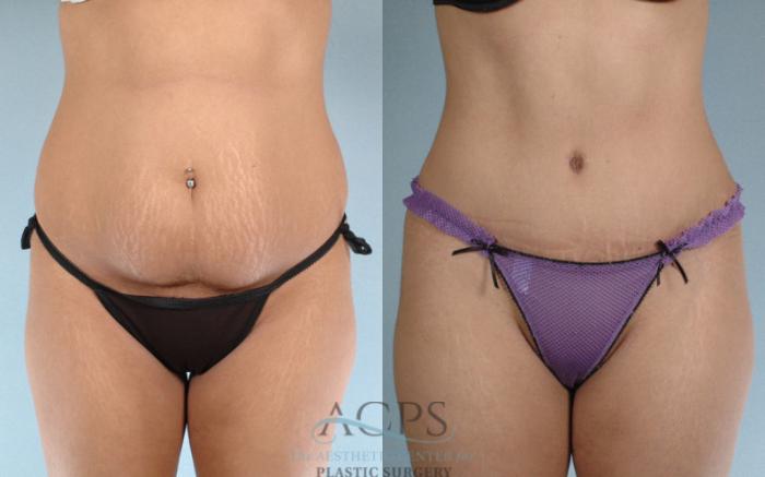 Before & After Tummy Tuck Case 82 Front View: View in Houston, TX
