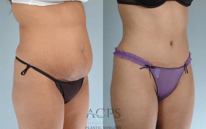 Before & After Tummy Tuck Case 82 Oblique View: View in Houston, TX