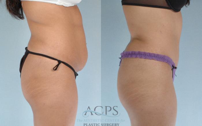 Before & After Tummy Tuck Case 82 Side View: View in Houston, TX