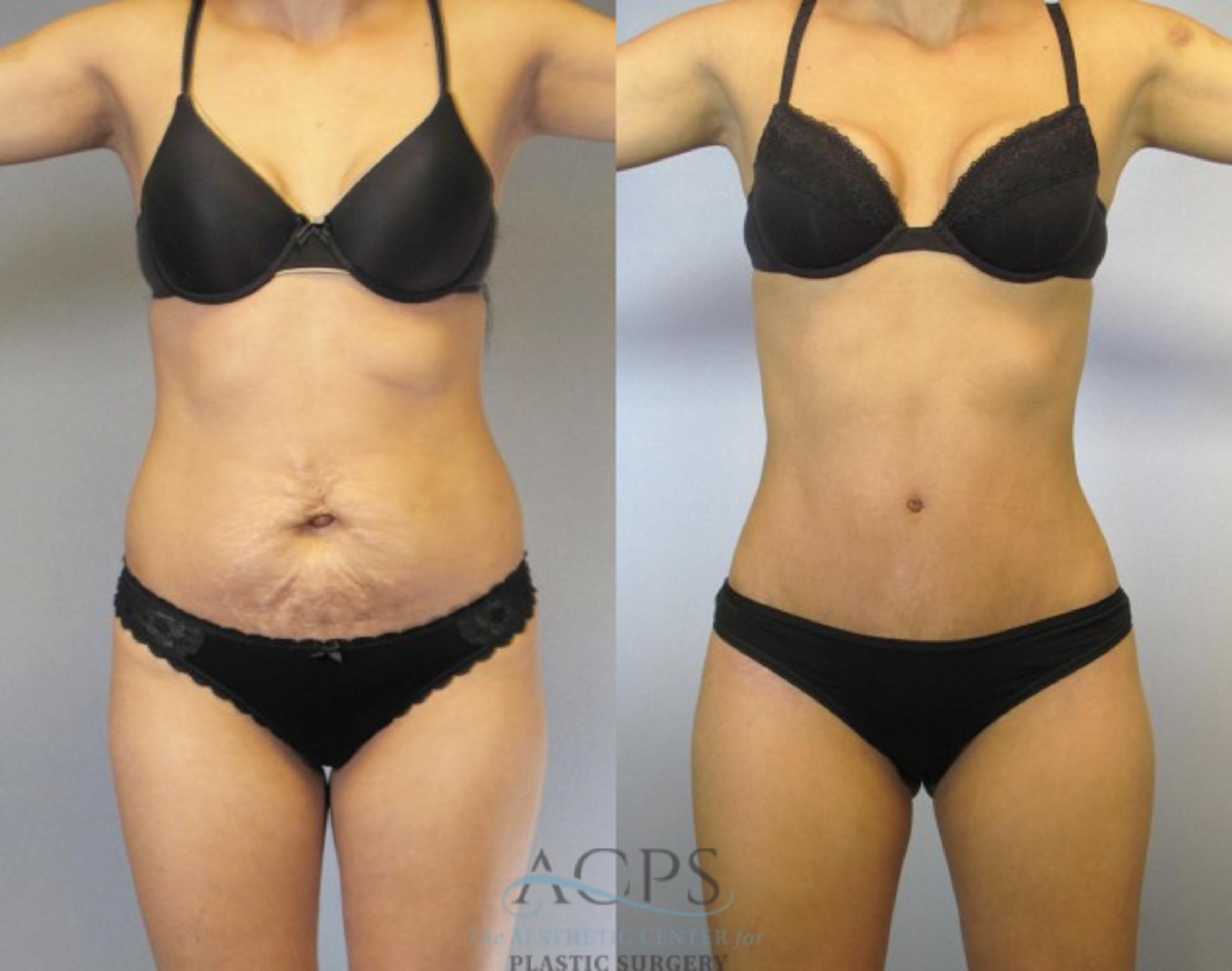 Before & After Tummy Tuck Case 83 Front View: View in Houston, TX