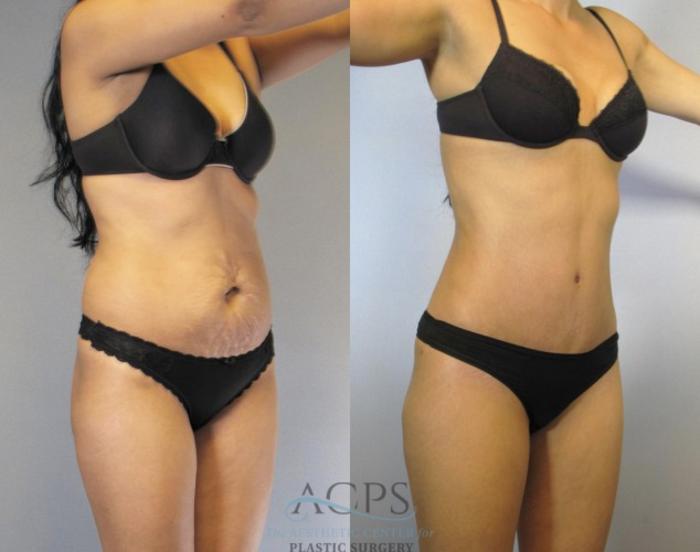 Before & After Tummy Tuck Case 83 Oblique View: View in Houston, TX