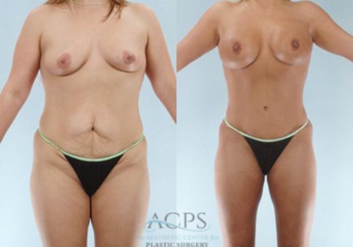 Before & After Tummy Tuck Case 84 Front View: View in Houston, TX