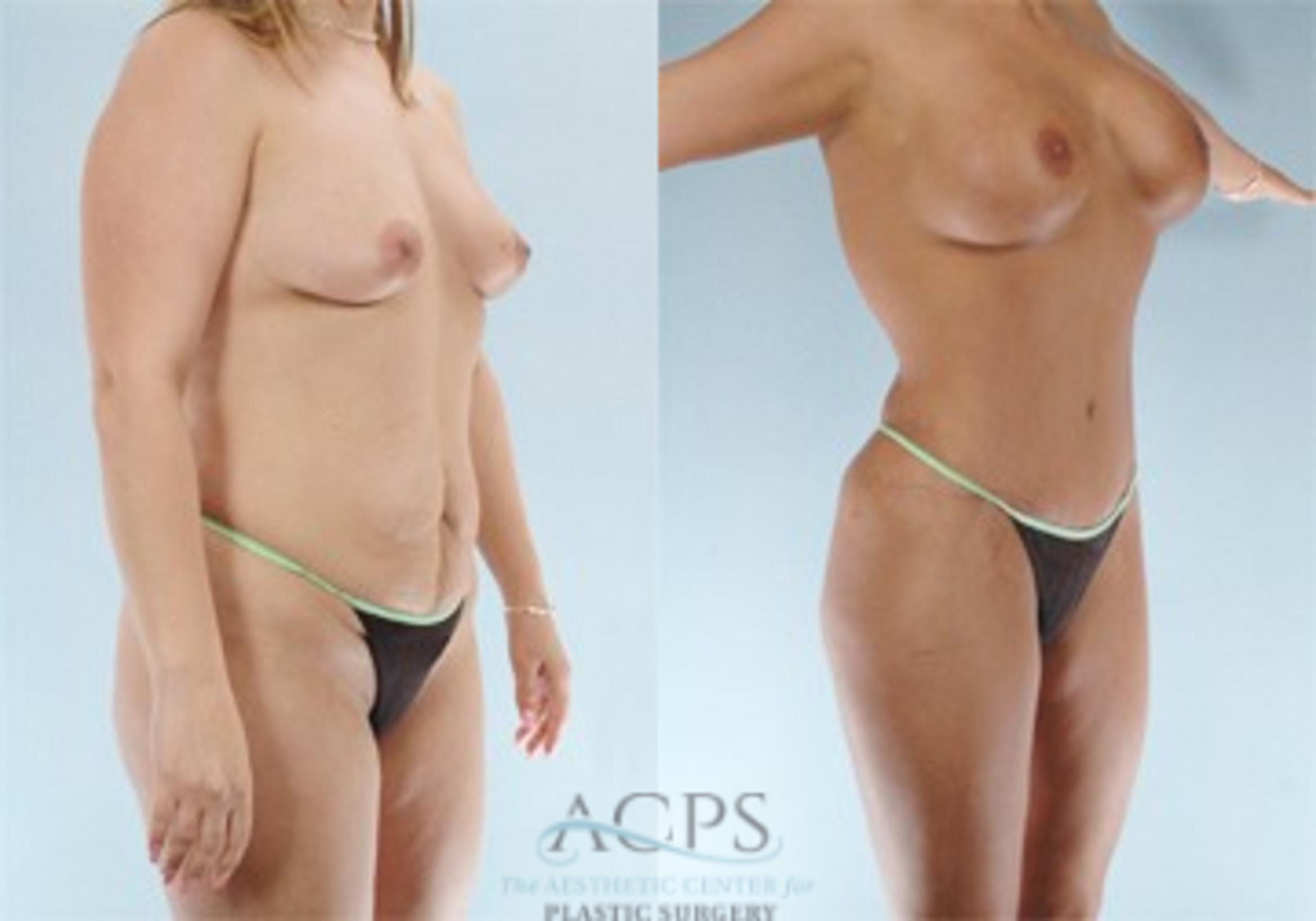 Before & After Tummy Tuck Case 84 Oblique View: View in Houston, TX