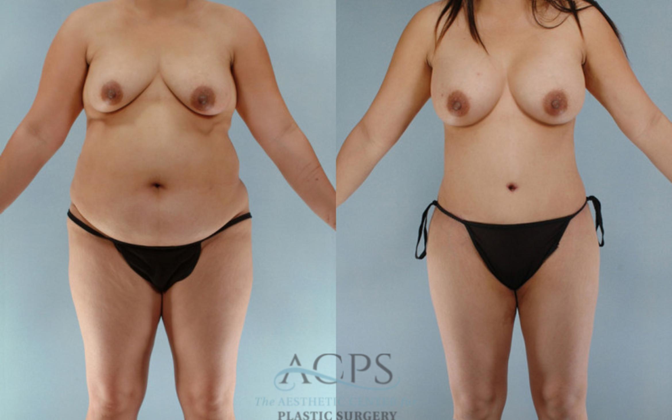 Before & After Tummy Tuck Case 85 Front View: View in Houston, TX