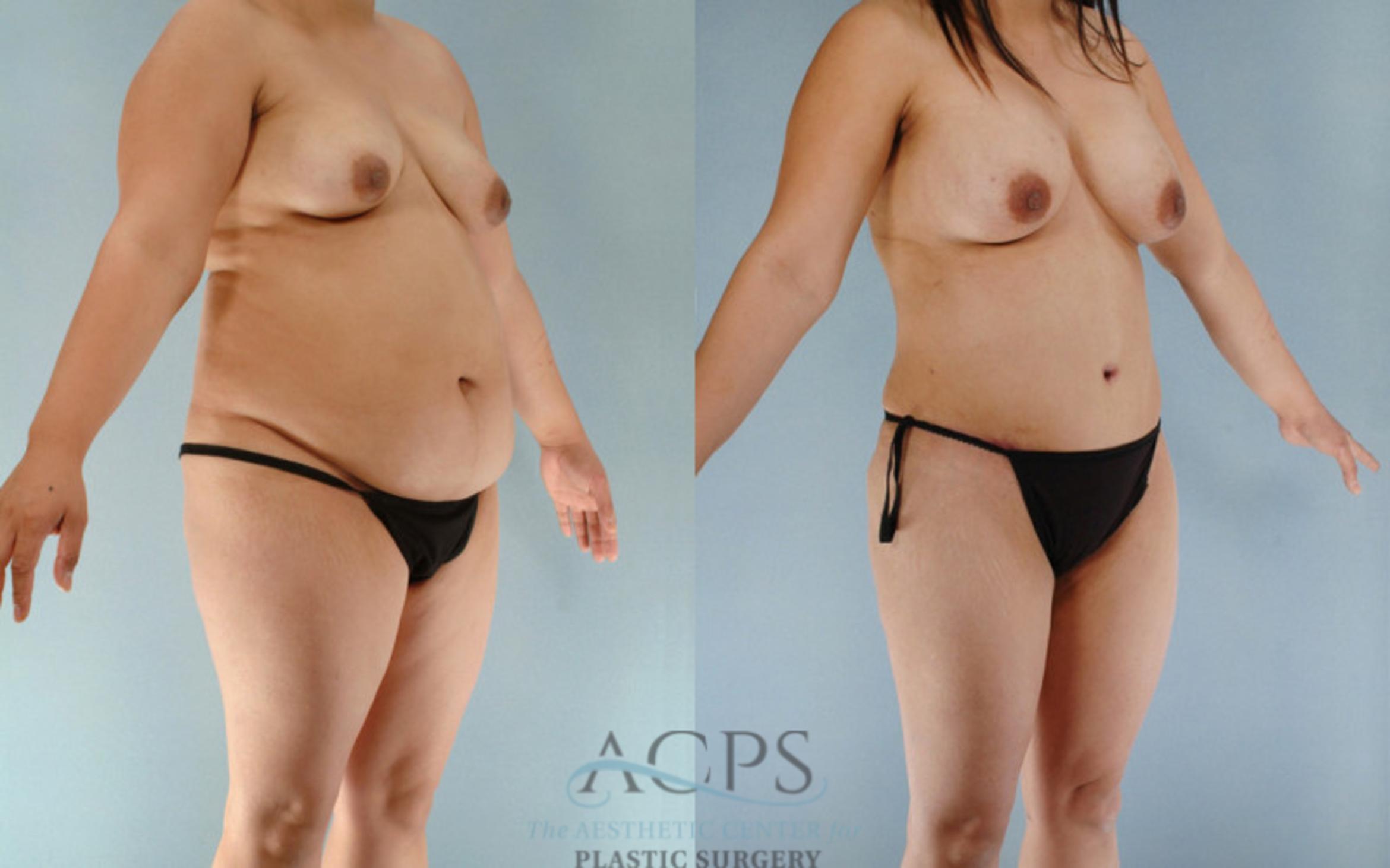 Before & After Tummy Tuck Case 85 Oblique View: View in Houston, TX