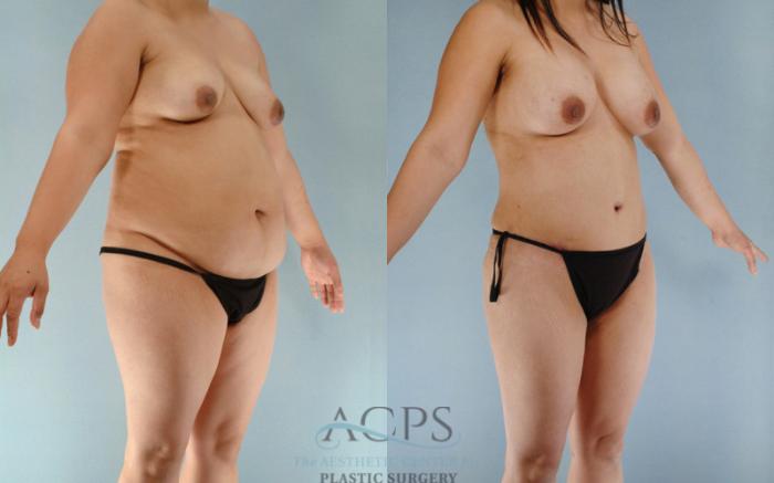 Before & After Tummy Tuck Case 85 Oblique View: View in Houston, TX