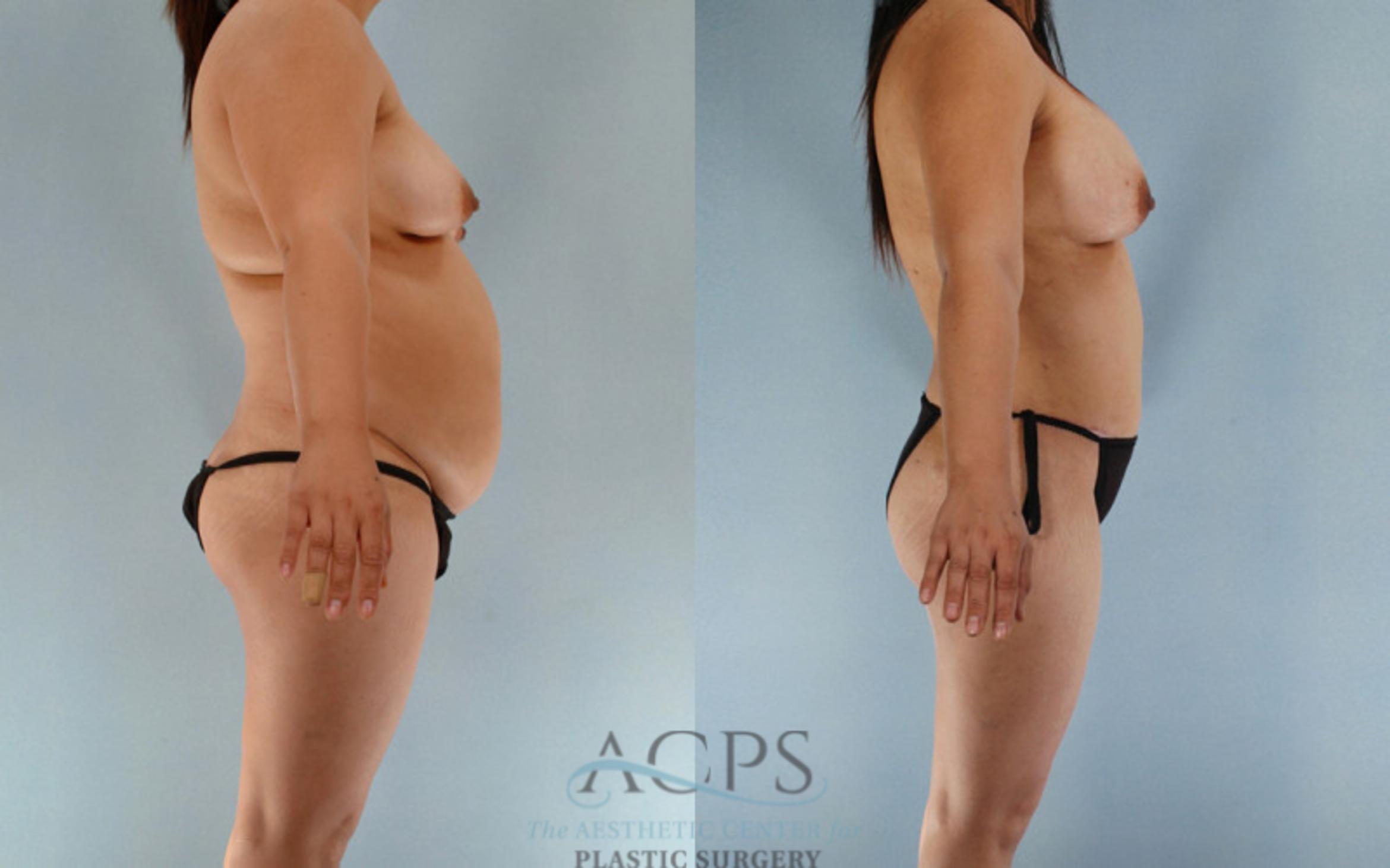 Before & After Tummy Tuck Case 85 Side View: View in Houston, TX