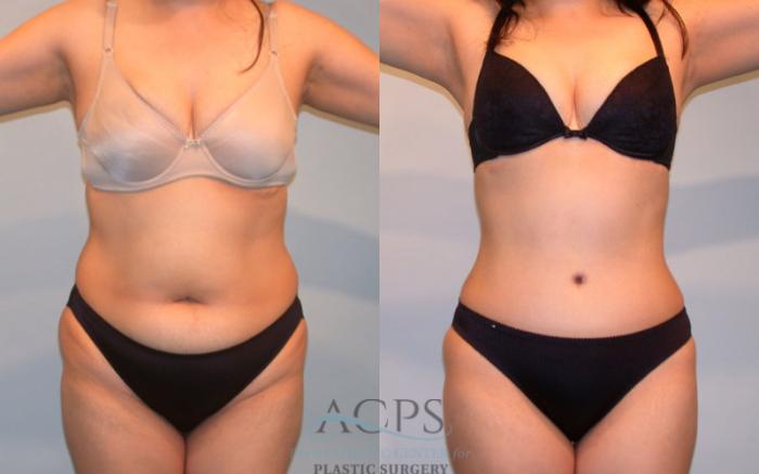 Before & After Tummy Tuck Case 86 Front View: View in Houston, TX