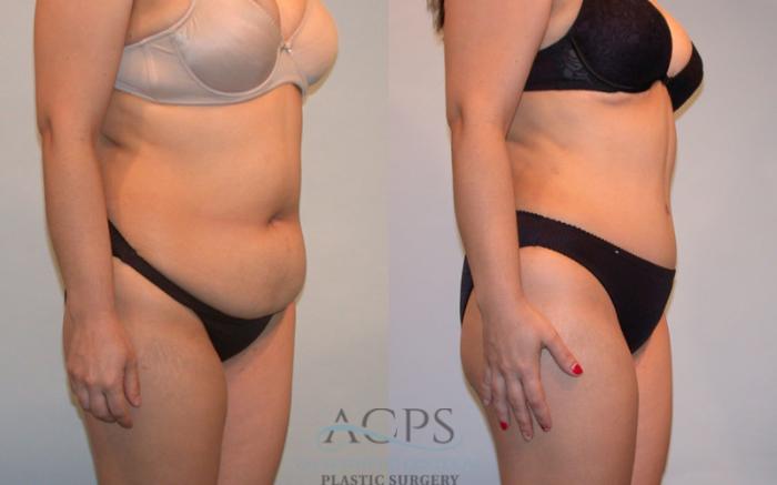 Before & After Tummy Tuck Case 86 Oblique View: View in Houston, TX