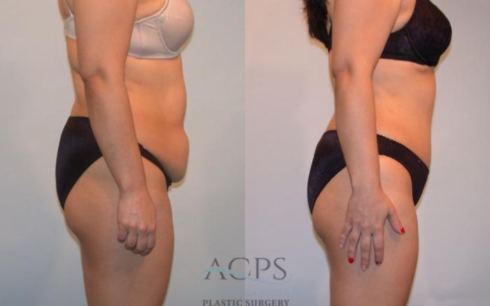 Before & After Tummy Tuck Case 86 Side View: View in Houston, TX