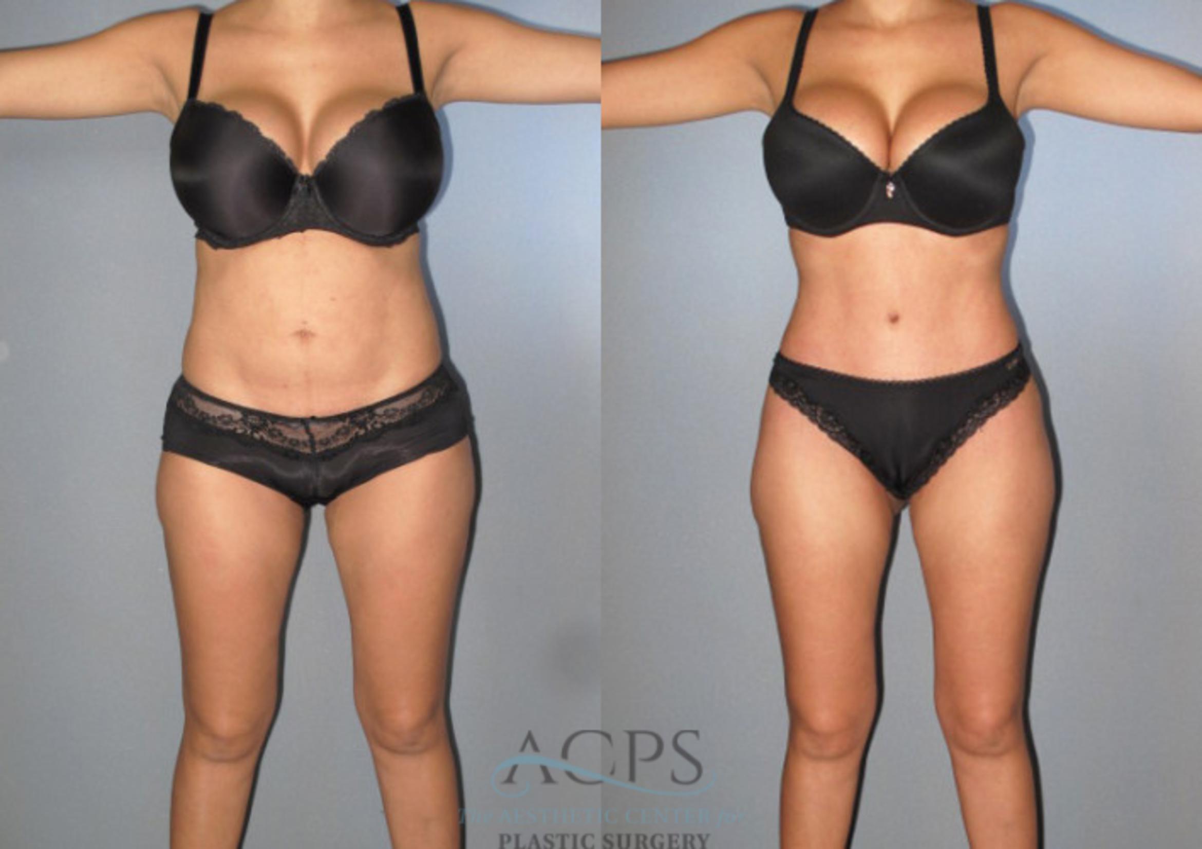 Before & After Tummy Tuck Case 87 Front View: View in Houston, TX