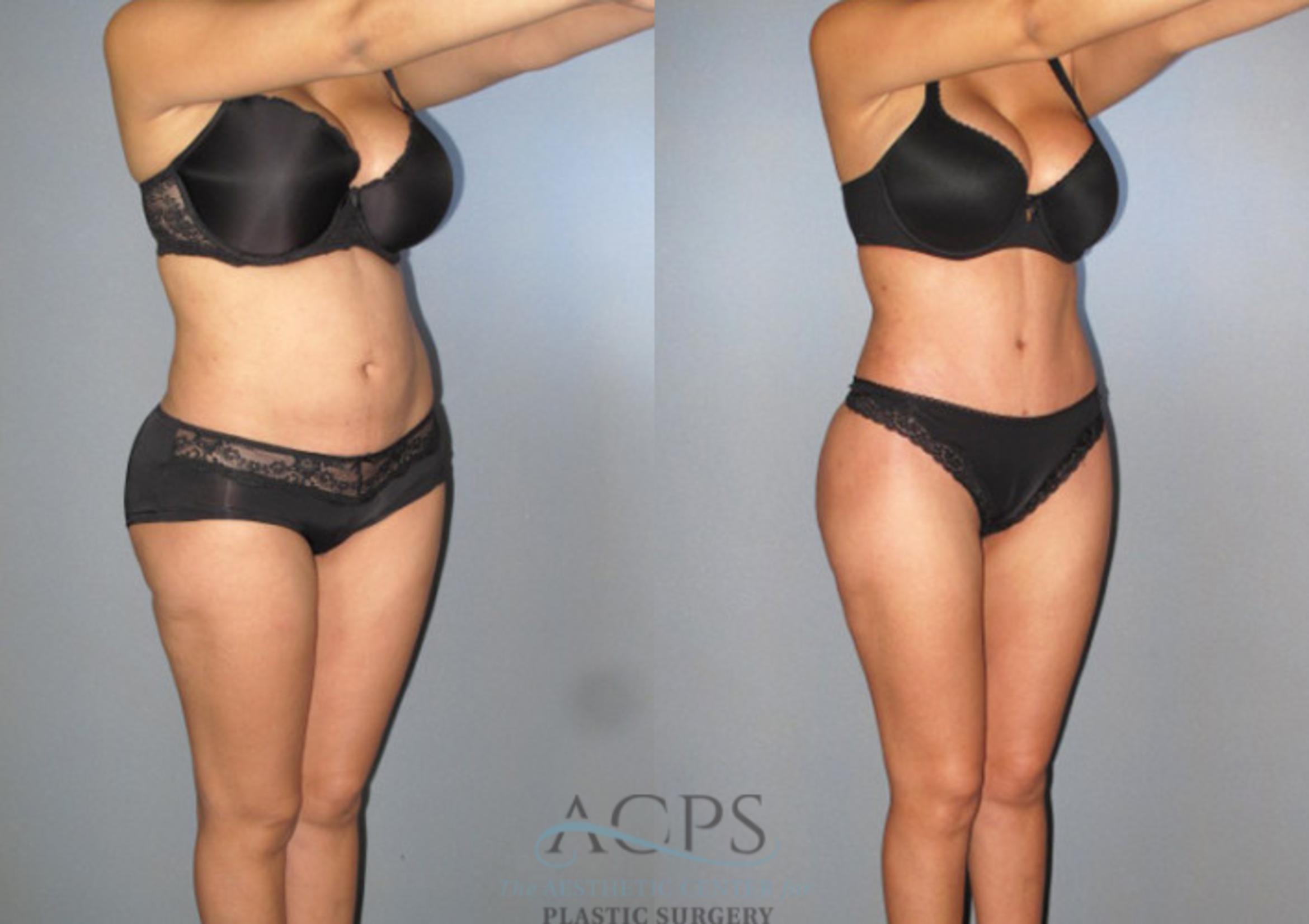 Before & After Tummy Tuck Case 87 Oblique View: View in Houston, TX