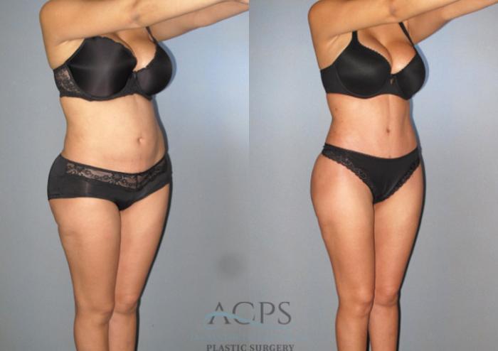 Before & After Tummy Tuck Case 87 Oblique View: View in Houston, TX