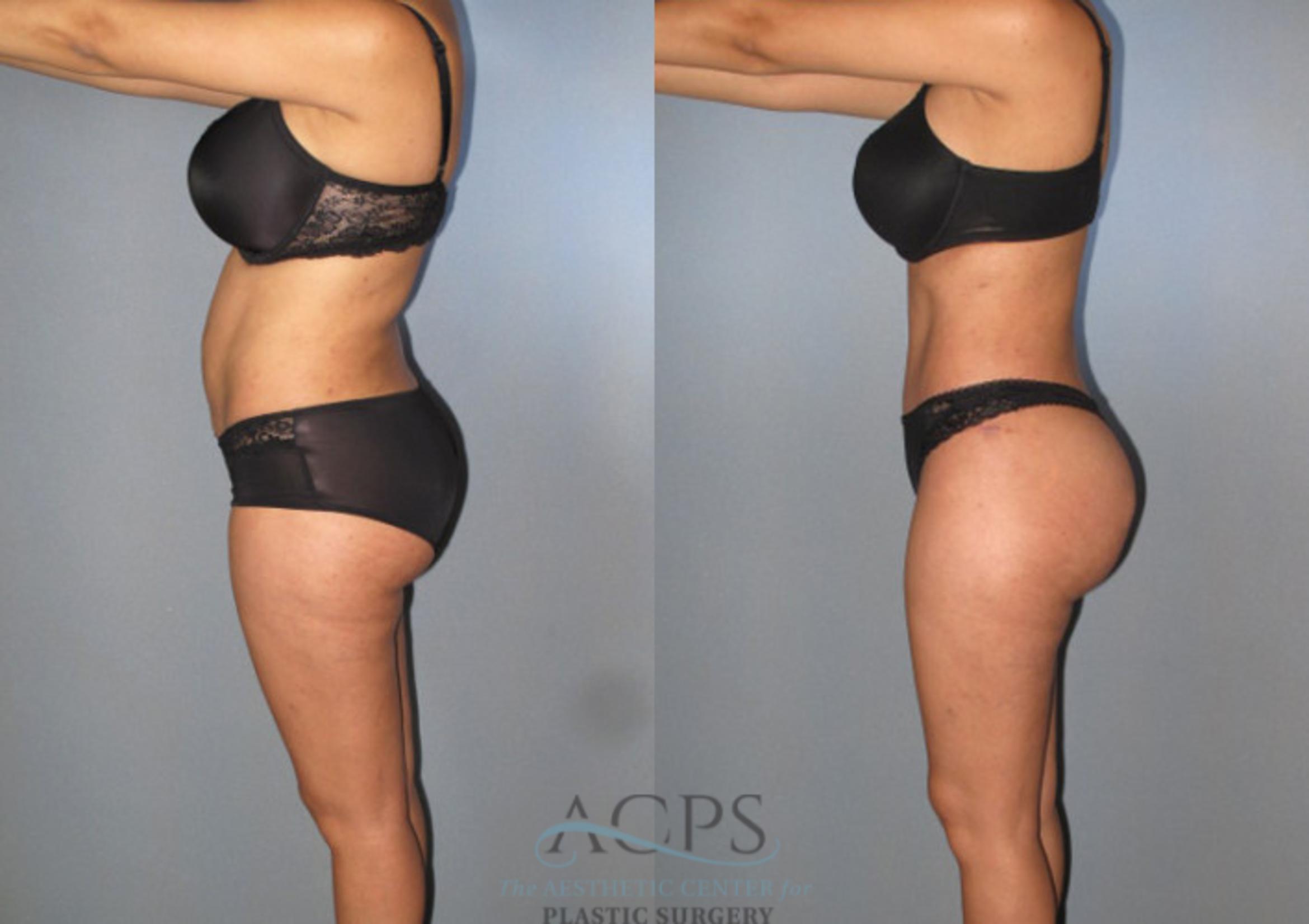 Before & After Tummy Tuck Case 87 Side View: View in Houston, TX