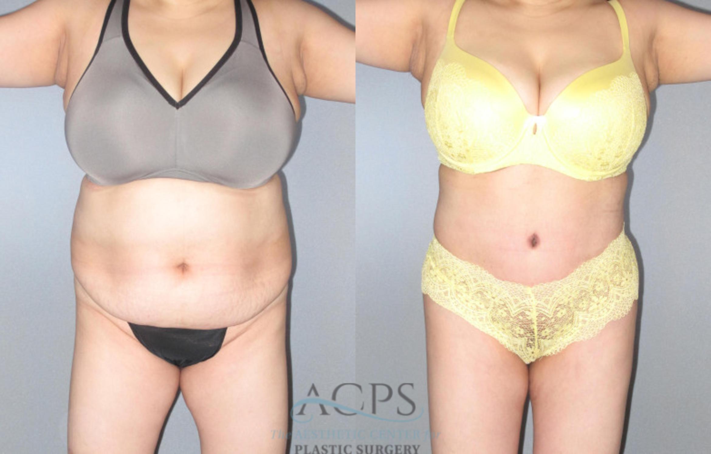 Before & After Tummy Tuck Case 88 Front View: View in Houston, TX