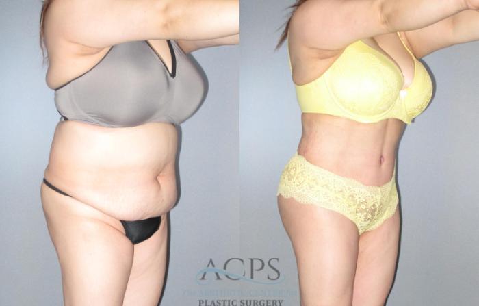 Before & After Tummy Tuck Case 88 Oblique View: View in Houston, TX