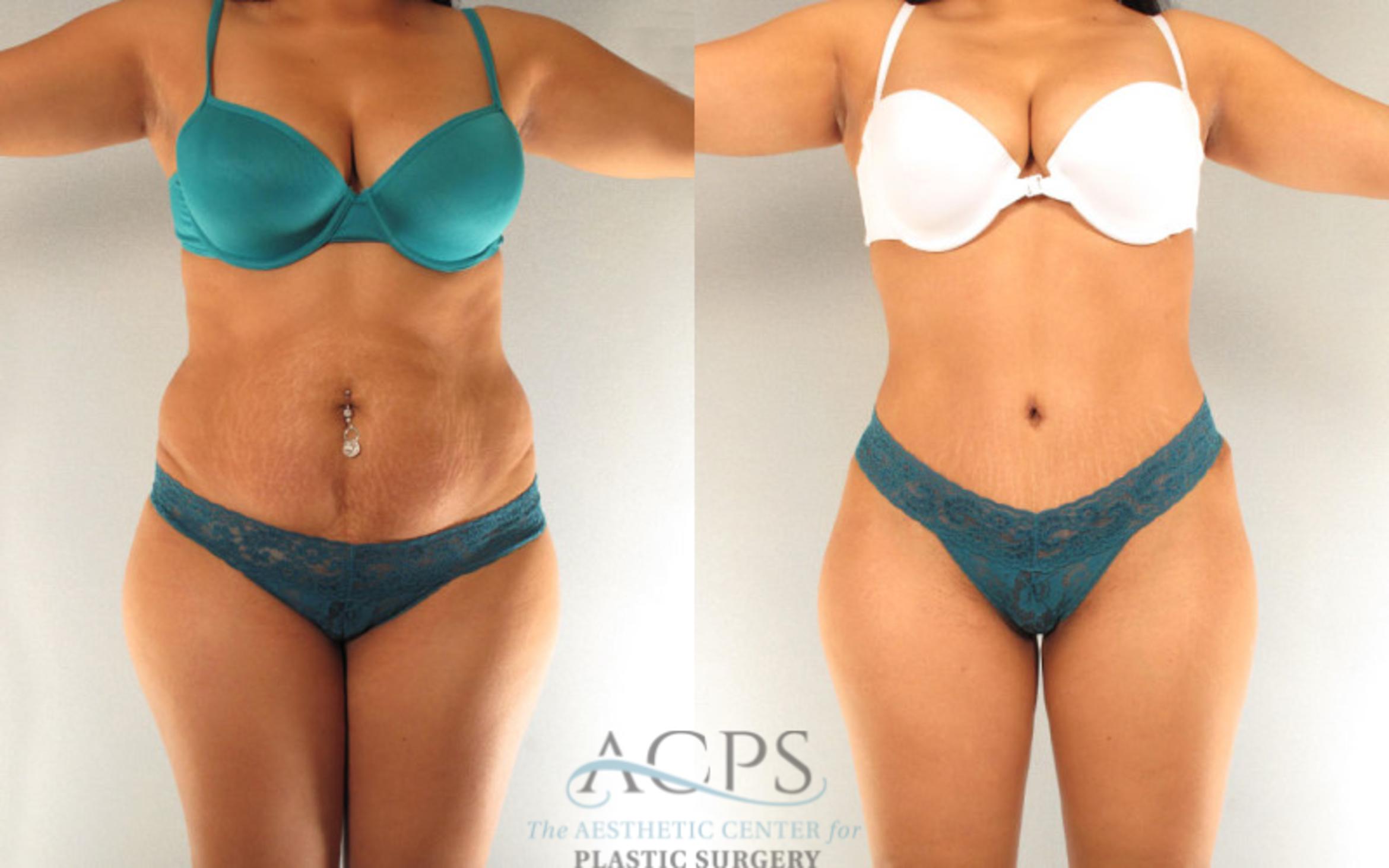 Before & After Tummy Tuck Case 89 Front View: View in Houston, TX