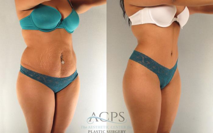 Before & After Tummy Tuck Case 89 Oblique View: View in Houston, TX
