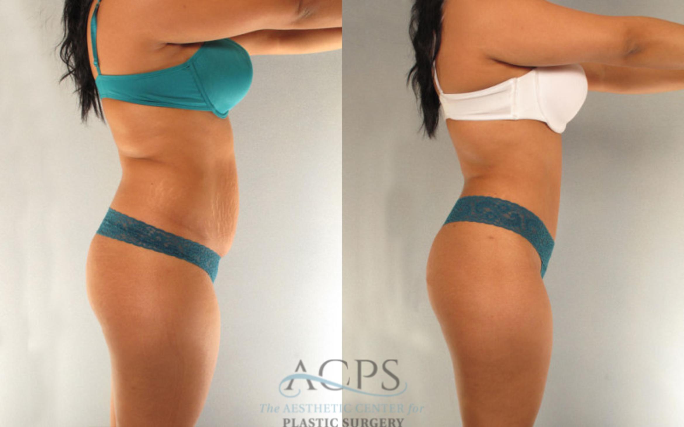 Before & After Tummy Tuck Case 89 Side View: View in Houston, TX