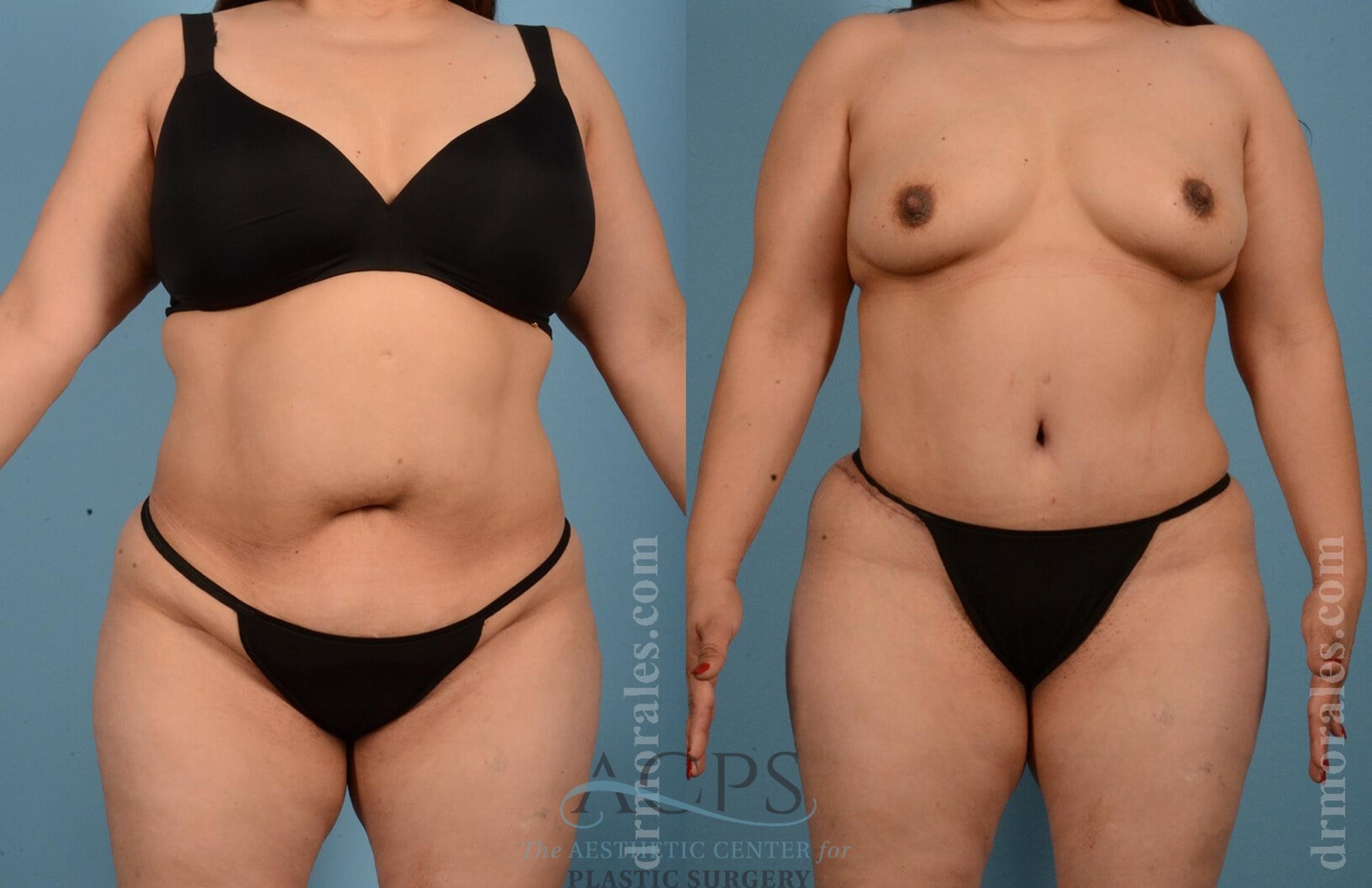 Before & After Tummy Tuck Case 9 Front View: View in Houston, TX
