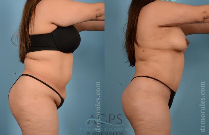 Before & After Tummy Tuck Case 9 Side View: View in Houston, TX