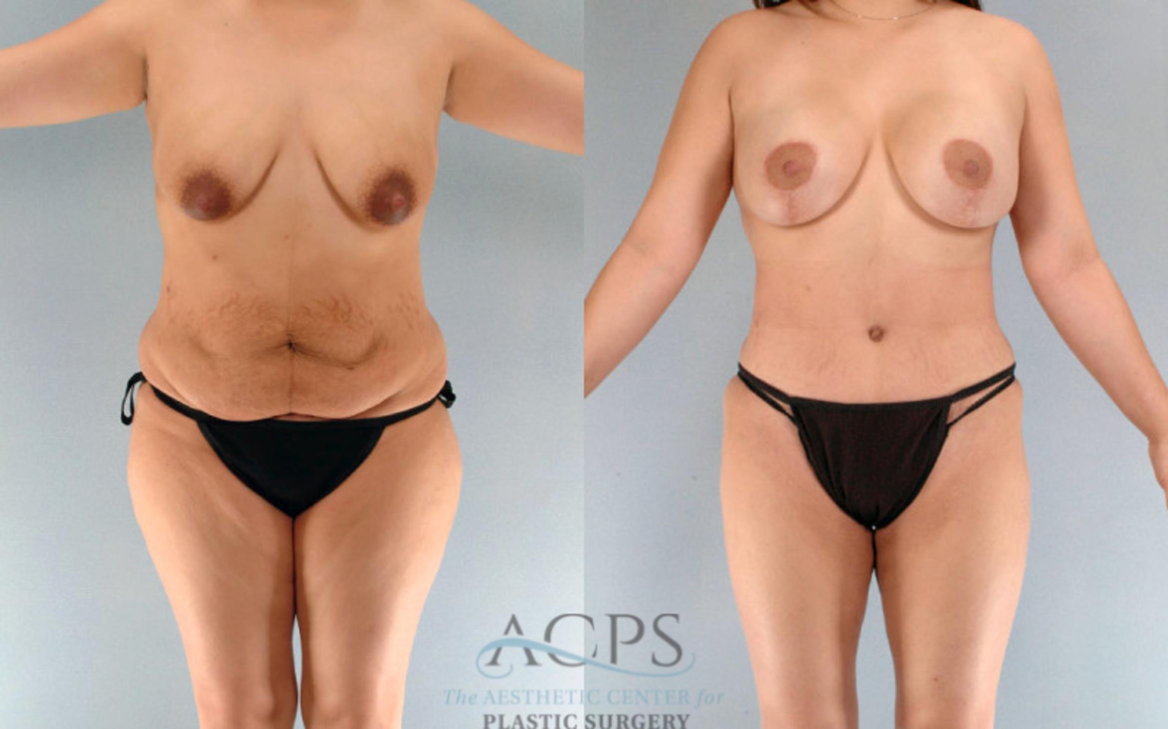 Before & After Tummy Tuck Case 90 Front View: View in Houston, TX