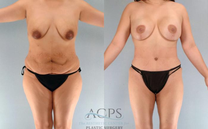 Before & After Tummy Tuck Case 90 Front View: View in Houston, TX
