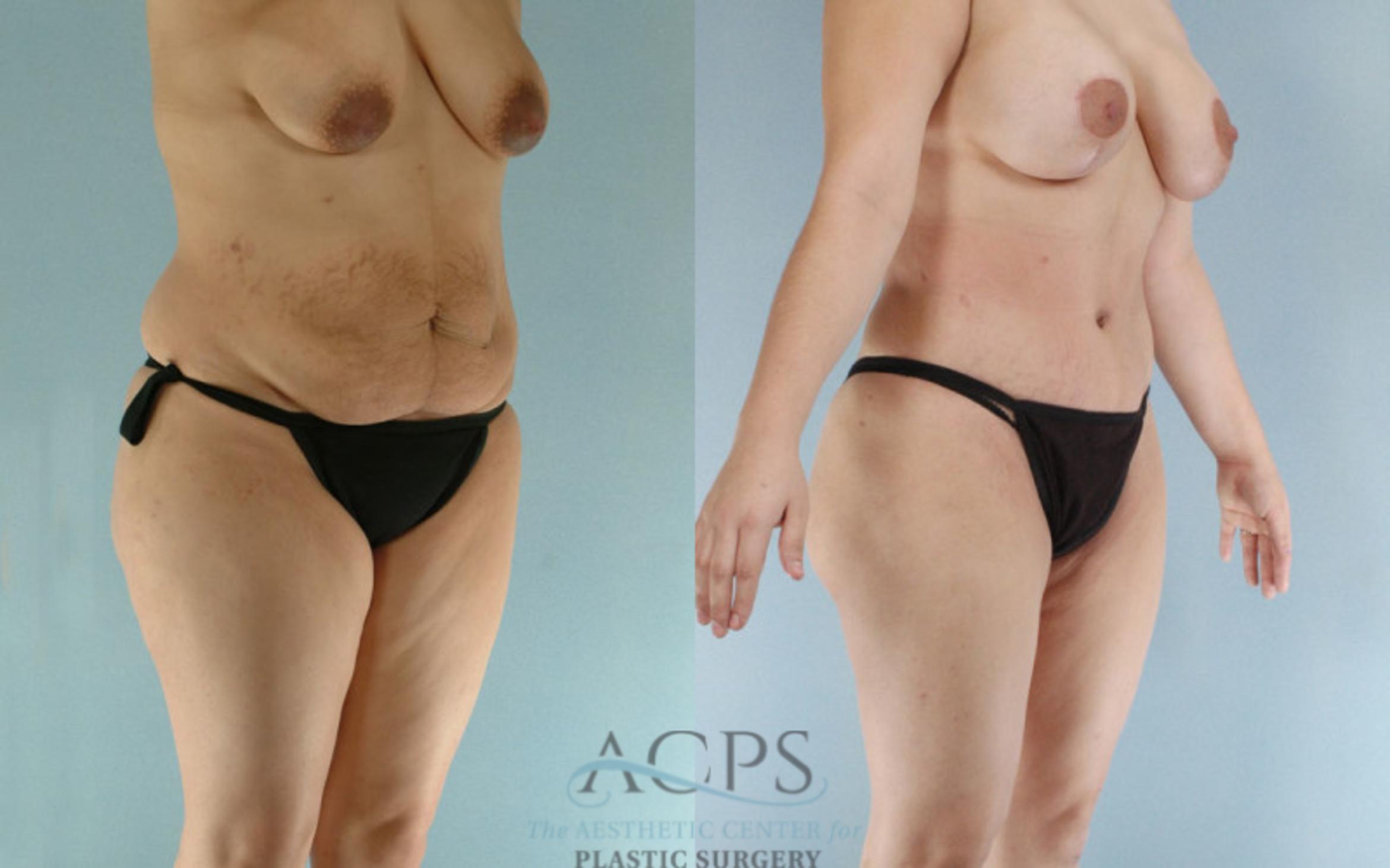 Before & After Tummy Tuck Case 90 Oblique View: View in Houston, TX