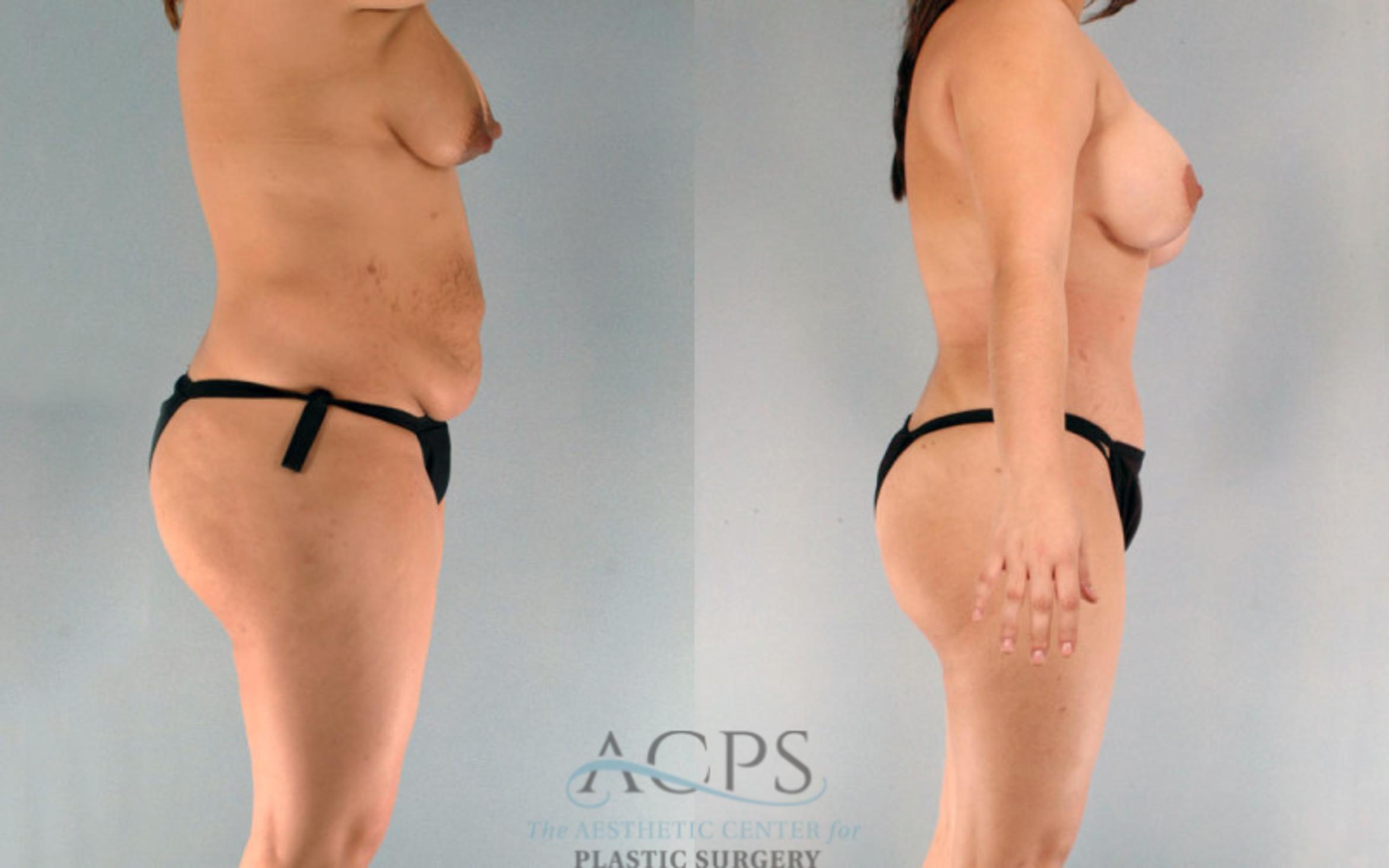 Before & After Tummy Tuck Case 90 Side View: View in Houston, TX