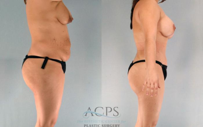 Before & After Tummy Tuck Case 90 Side View: View in Houston, TX