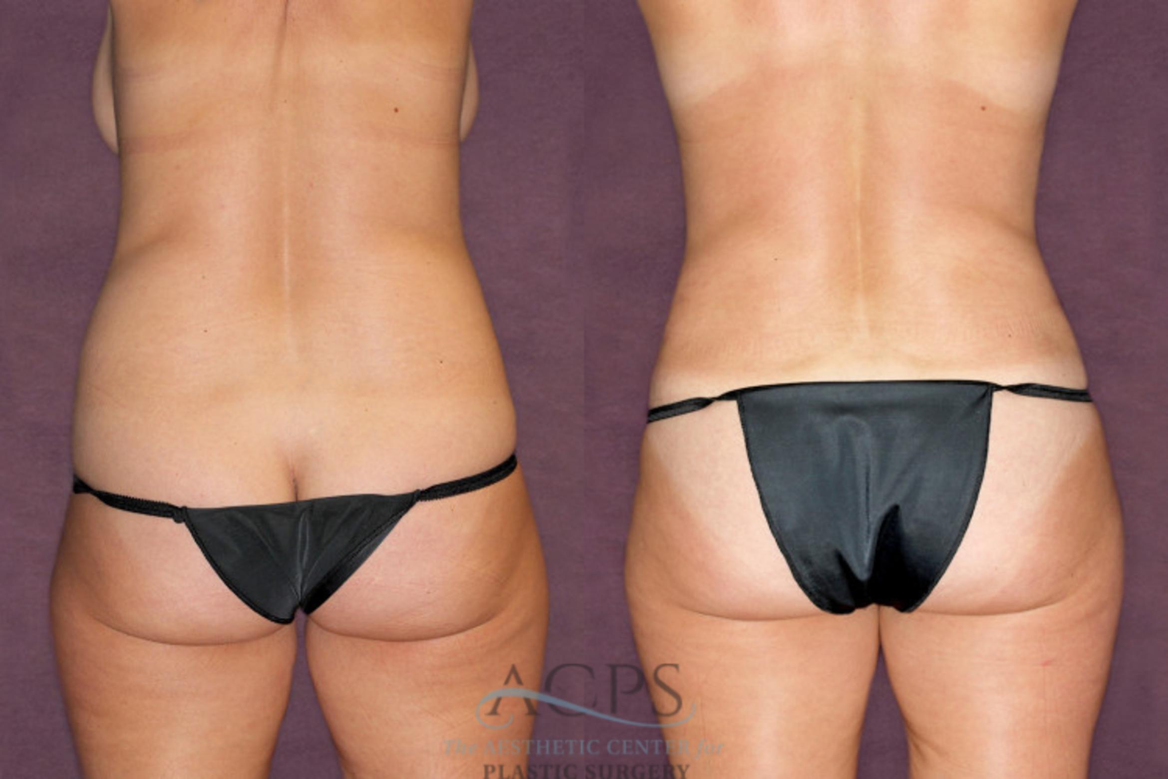 Before & After Tummy Tuck Case 91 Rear View: View in Houston, TX