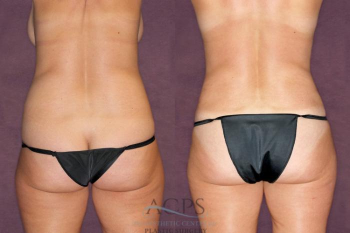 Before & After Tummy Tuck Case 91 Rear View: View in Houston, TX
